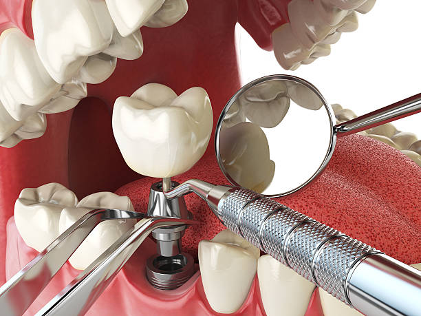 Best Broken or Cracked Tooth Emergency Dentist in Rockwell, NC